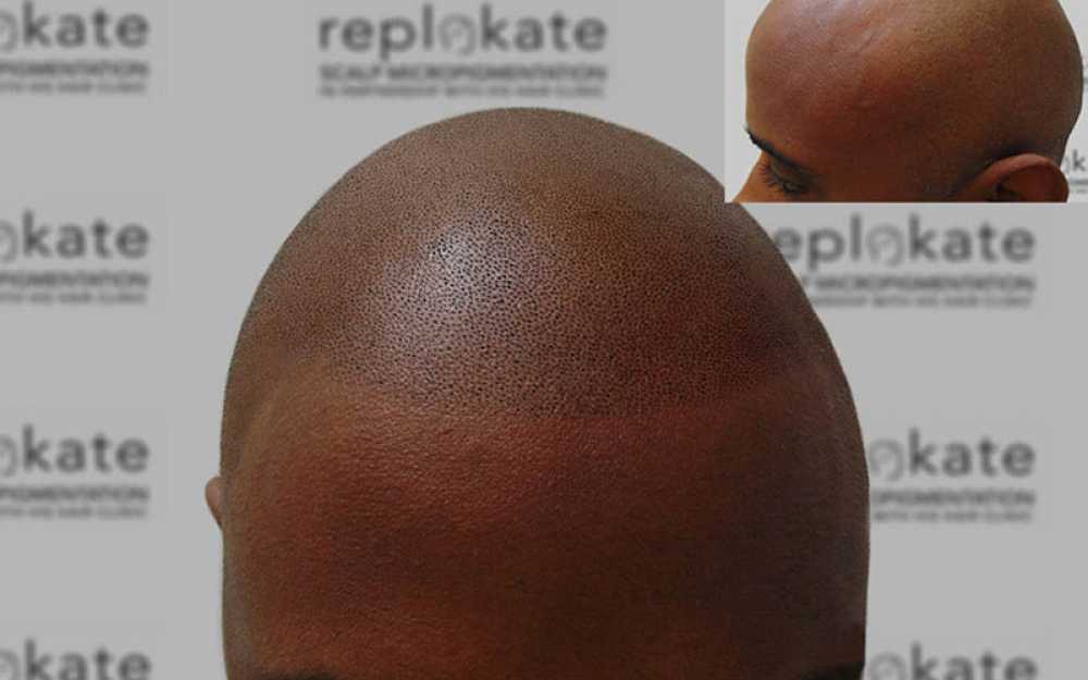 Crown Balding & Complete Hair Loss #3
